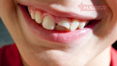 Rüyada diş kırılmasının anlamı, kaygı ile ilişkisi ve duygusal durumu