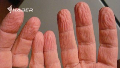 Suya uzun süre maruz kaldığınızda, parmaklarınızın buruştuğunu fark etmişsinizdir. Peki,