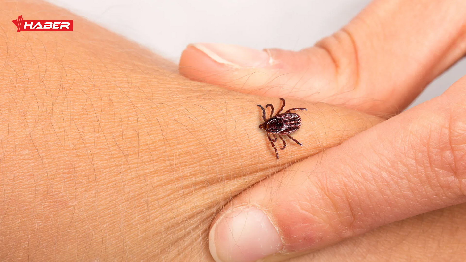 kene ısırdığında ne yapılır