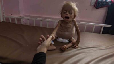 Gazze Şeridi'nde İsrail ablukası sonucu açlık ve yetersiz beslenmeden kaynaklanan