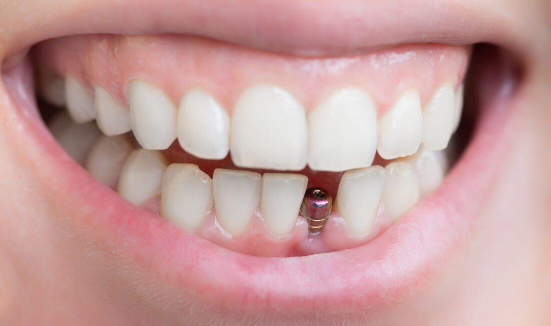 Diş eksikliği, hem estetik kaygılara hem de çiğneme fonksiyonunun bozulmasına