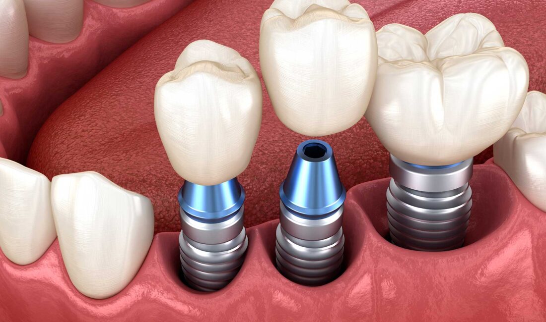 Diş eksikliği yaşayan birçok kişi için diş implantı, en kalıcı