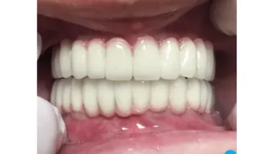 Vidasız implant, geleneksel vidalı implant sistemlerine alternatif olarak geliştirilen, modern