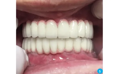 Vidasız implant, geleneksel vidalı implant sistemlerine alternatif olarak geliştirilen, modern