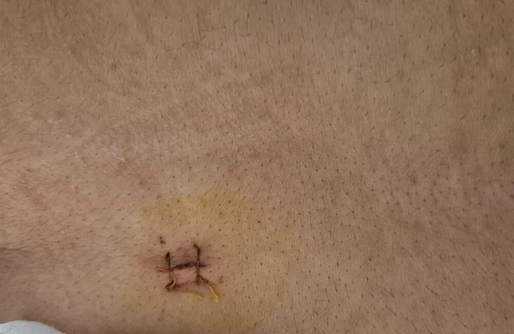 Yozgat Şehir Hastanesi’nde ileri cerrahi yöntemlerle bir başarıya daha imza