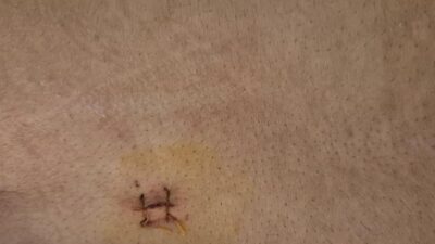 Yozgat Şehir Hastanesi’nde ileri cerrahi yöntemlerle bir başarıya daha imza