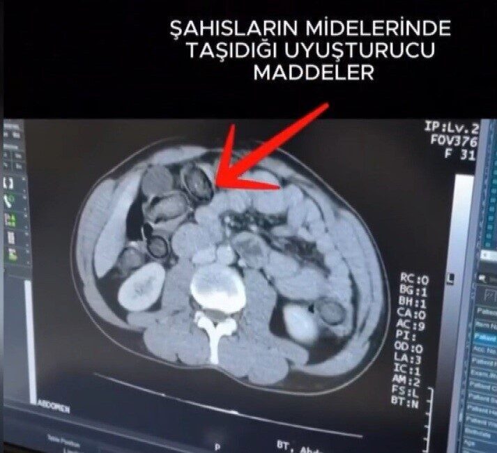 Erzincan’da gerçekleştirilen narkotik operasyonunda 983,18 gram metamfetamin ele geçirildi ve