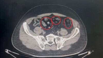 Bitlis’in Tatvan ilçesinde bir yolcunun mide ve bağırsaklarında 62 parça