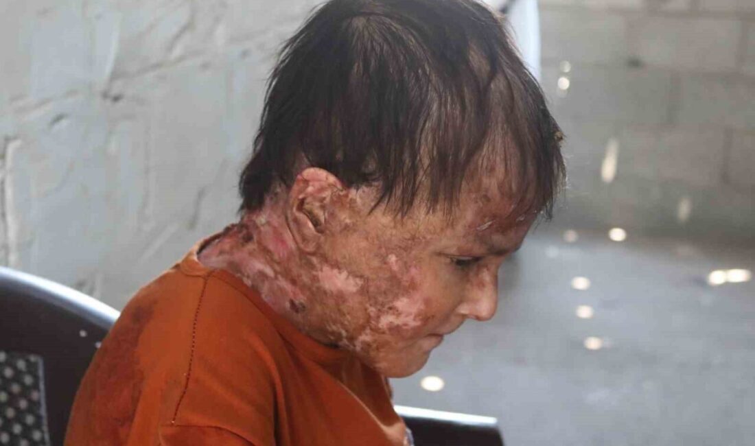 Gazze Şeridi’nde “Kelebek Hastalığı” olarak da bilinen nadir görülen bir