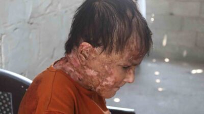 Gazze Şeridi’nde “Kelebek Hastalığı” olarak da bilinen nadir görülen bir