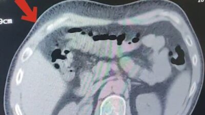 Yabancı bir yolcunun mide ve bağırsaklarında bulunan 608 gram metamfetamin