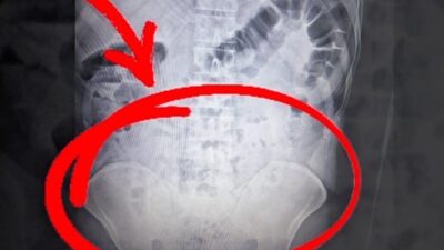Aksaray’da gerçekleştirilen uyuşturucu operasyonunda, 4 kişinin mideye sakladığı toplam 1